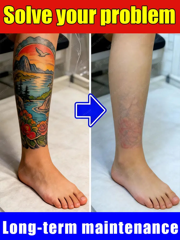2026 Hot sale For the removal of colored permanent makeup tattoos,pattern tattoo removal